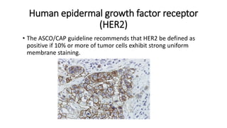 Human epidermal growth factor receptor
(HER2)
• The ASCO/CAP guideline recommends that HER2 be defined as
positive if 10% or more of tumor cells exhibit strong uniform
membrane staining.
 