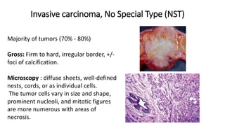 Invasive carcinoma, No Special Type (NST)
Majority of tumors (70% - 80%)
Gross: Firm to hard, irregular border, +/-
foci of calcification.
Microscopy : diffuse sheets, well-defined
nests, cords, or as individual cells.
The tumor cells vary in size and shape,
prominent nucleoli, and mitotic figures
are more numerous with areas of
necrosis.
 