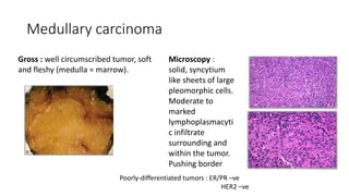 Medullary carcinoma
Gross : well circumscribed tumor, soft
and fleshy (medulla = marrow).
Microscopy :
solid, syncytium
like sheets of large
pleomorphic cells.
Moderate to
marked
lymphoplasmacyti
c infiltrate
surrounding and
within the tumor.
Pushing border
Poorly-differentiated tumors : ER/PR –ve
HER2 –ve
 
