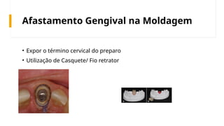 Afastamento Gengival na Moldagem
• Expor o término cervical do preparo
• Utilização de Casquete/ Fio retrator
 