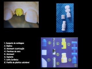 1. Casquete de moldagem
2. Réplica
3. Abutment cicatrização
4. Parafuso de ouro
5. Abutment
6. Implante
7. Coifa Cerâmica
8. Padrão de plástico calcinável
 