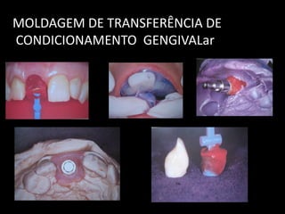 MOLDAGEM DE TRANSFERÊNCIA DE
CONDICIONAMENTO GENGIVALar
 