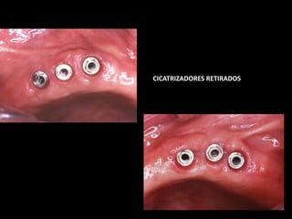 CICATRIZADORES RETIRADOS
 
