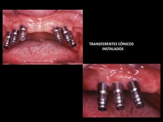 TRANSFERENTES CÔNICOS
      INSTALADOS
 