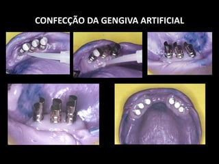 CONFECÇÃO DA GENGIVA ARTIFICIAL
 