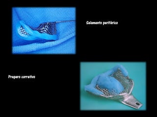 Selamento periférico




Preparo corretivo
 