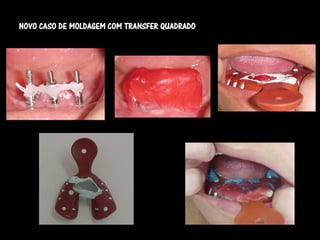 NOVO CASO DE MOLDAGEM COM TRANSFER QUADRADO
 