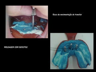 Risco de movimentação do transfer




MOLDAGEM COM DEFEITOS
 