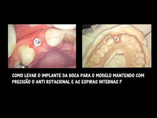 COMO LEVAR O IMPLANTE DA BOCA PARA O MODELO MANTENDO COM
PRECISÃO O ANTI ROTACIONAL E AS ESPIRAS INTERNAS ?
 