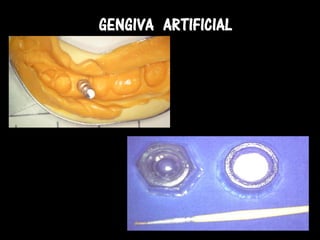 GENGIVA ARTIFICIAL
 