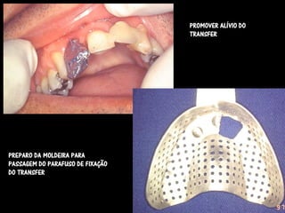 PROMOVER ALÍVIO DO
                                  TRANSFER




PREPARO DA MOLDEIRA PARA
PASSAGEM DO PARAFUSO DE FIXAÇÃO
DO TRANSFER
 