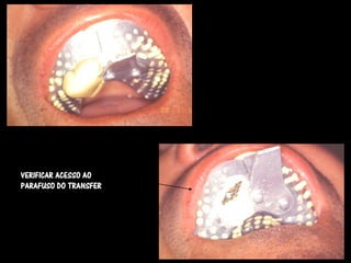 VERIFICAR ACESSO AO
PARAFUSO DO TRANSFER
 