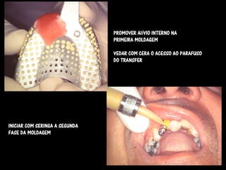 PROMOVER AlíVIO INTERNO NA
                                PRIMEIRA MOLDAGEM

                                VEDAR COM CERA O ACESSO AO PARAFUSO
                                DO TRANSFER




INICIAR COM SERINGA A SEGUNDA
FASE DA MOLDAGEM
 