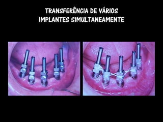 TRANSFERÊNCIA DE VÁRIOS
IMPLANTES SIMULTANEAMENTE
 