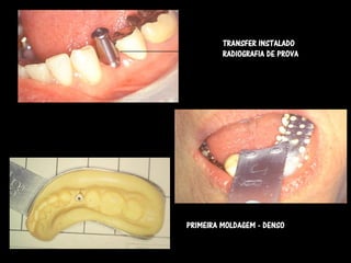 TRANSFER INSTALADO
         RADIOGRAFIA DE PROVA




PRIMEIRA MOLDAGEM - DENSO
 