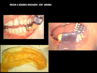 INICIAR A SEGUNDA MOLDAGEM COM SERINGA
 