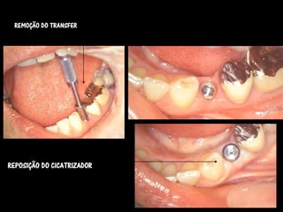 REMOÇÃO DO TRANSFER




REPOSIÇÃO DO CICATRIZADOR
 