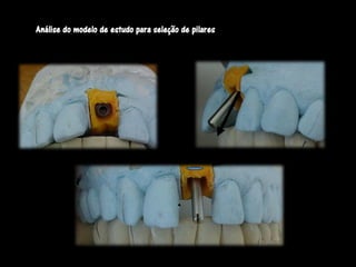 Análise do modelo de estudo para seleção de pilares
 