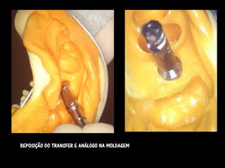 REPOSIÇÃO DO TRANSFER E ANÁLOGO NA MOLDAGEM
 