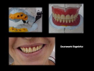 Enceramento Diagnóstico
 