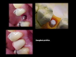 Emergência protética
 