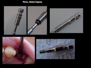 Morse, Ankylos Degussa
 