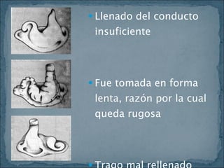Llenado del conducto insuficiente Fue tomada en forma lenta, razón por la cual queda rugosa Trago mal rellenado 