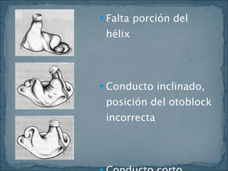 Falta porción del hélix Conducto inclinado, posición del otoblock incorrecta Conducto corto 