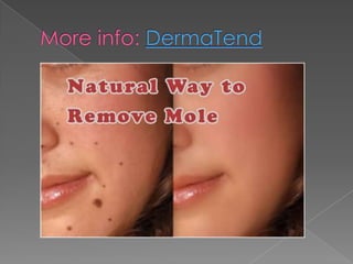 Mole removal | PPT