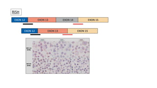 RISH
EXON 13 EXON 14 EXON 15
EXON 12
EXON 13 EXON 15
EXON 12
 