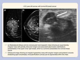 Molecular Classification and Radiological Phenotypes of Breast Cancer ...