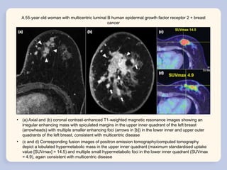 Molecular Classification and Radiological Phenotypes of Breast Cancer ...