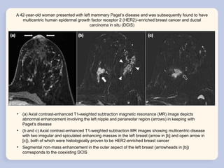 Molecular Classification and Radiological Phenotypes of Breast Cancer ...