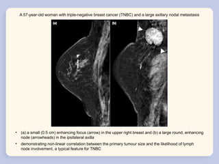 Molecular Classification and Radiological Phenotypes of Breast Cancer ...