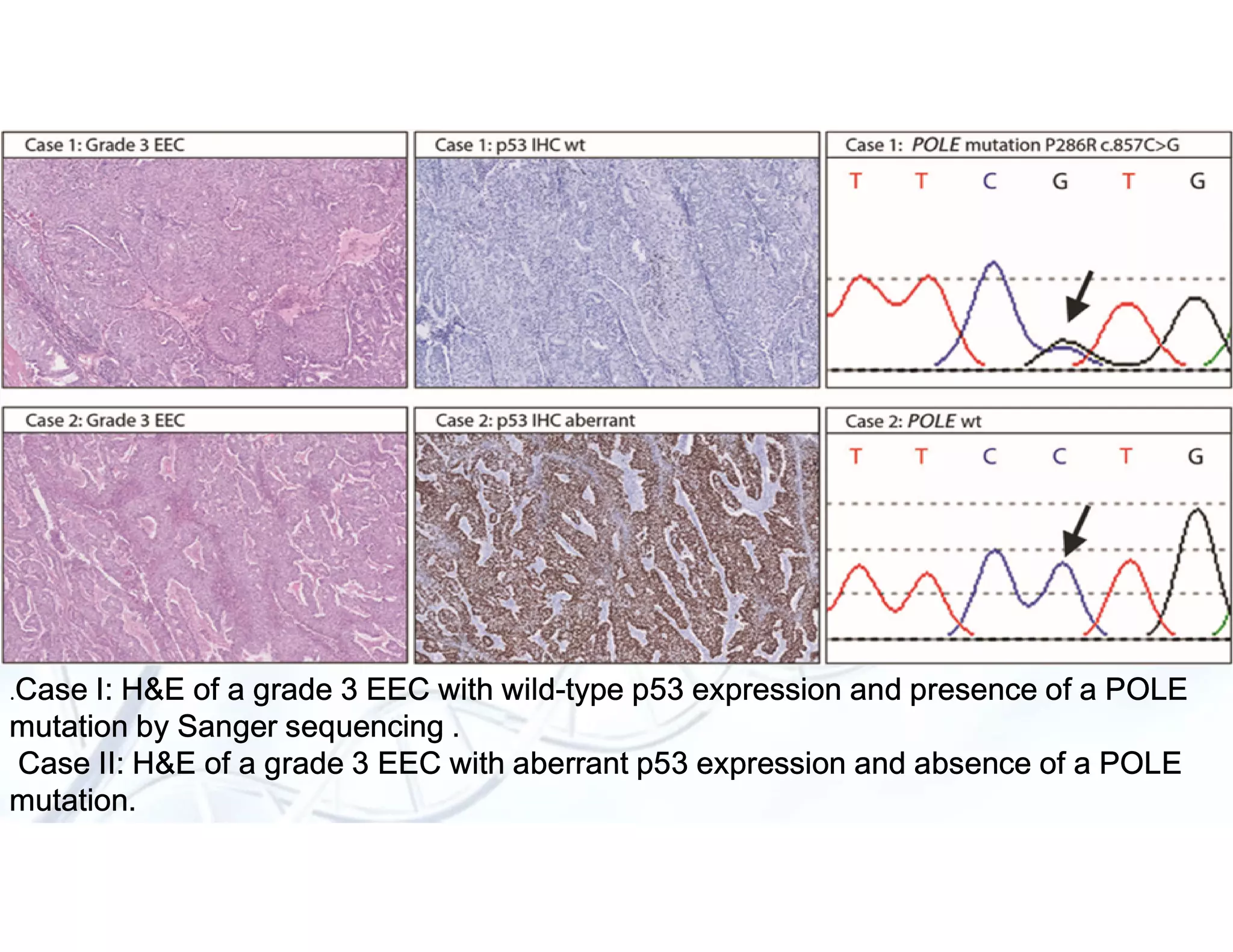 Molecular classification of endometrial cancer | PDF