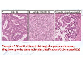 Molecular classification of endometrial cancer | PDF