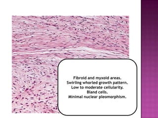 Fibroid and myxoid areas.
Swirling whorled growth pattern.
Low to moderate cellularity.
Bland cells.
Minimal nuclear pleomorphism.
 