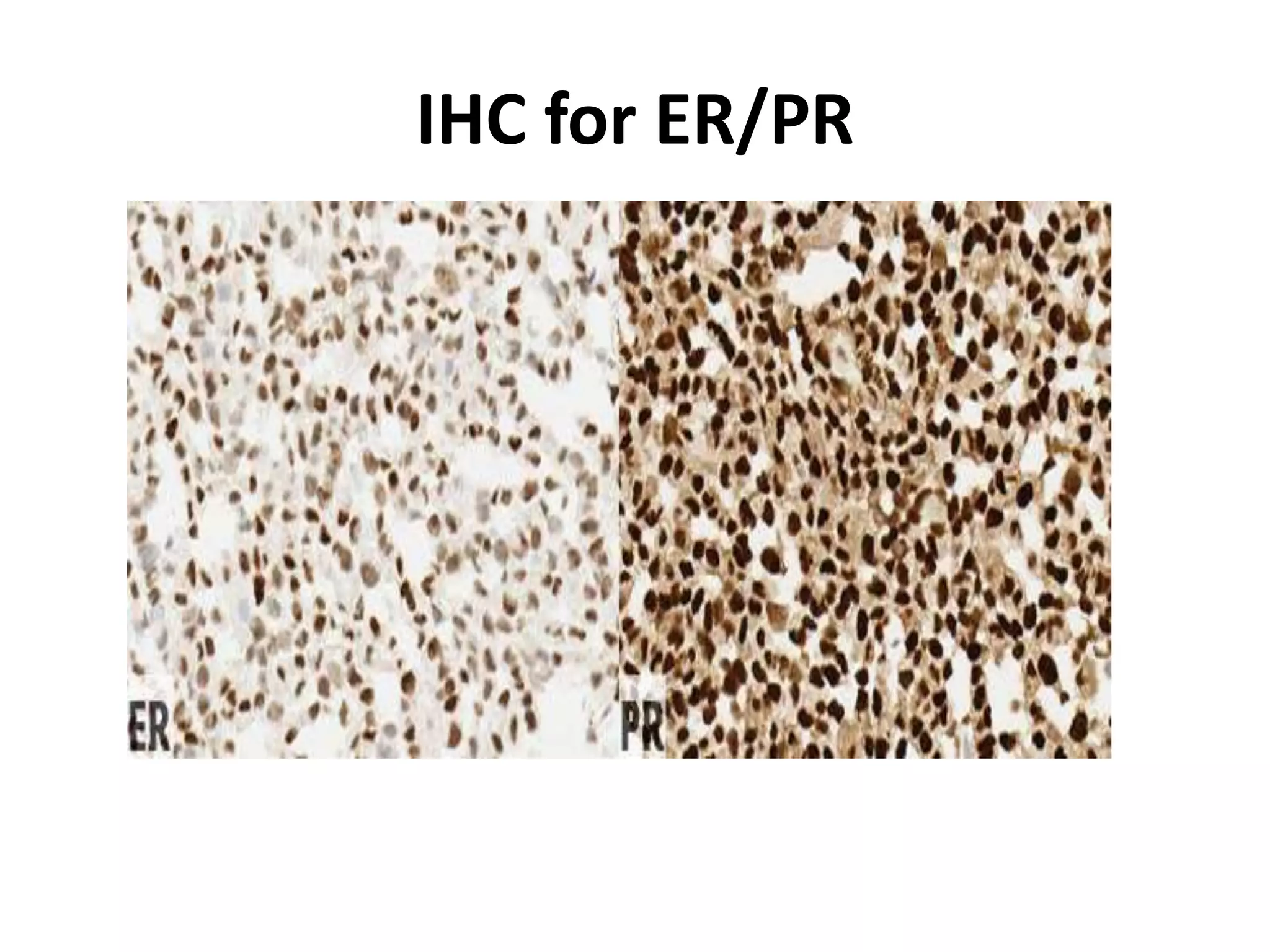 Molecular profiling of breast cancer | PPTX