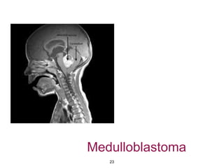 Medulloblastoma
23
 