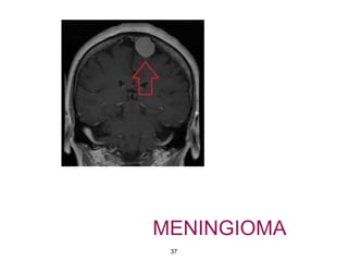 MENINGIOMA
37
 