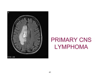 PRIMARY CNS
LYMPHOMA
41
 