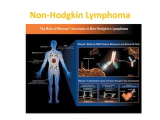 Non-Hodgkin Lymphoma
 
