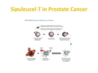 Sipuleucel-T in Prostate Cancer
 