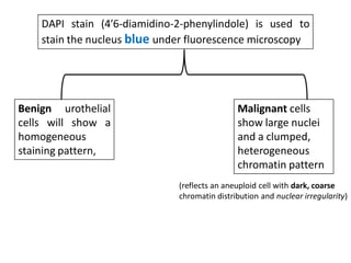 DAPI stain (4′6-diamidino-2-phenylindole) is used to
stain the nucleus blue under fluorescence microscopy
Benign urothelial
cells will show a
homogeneous
staining pattern,
Malignant cells
show large nuclei
and a clumped,
heterogeneous
chromatin pattern
(reflects an aneuploid cell with dark, coarse
chromatin distribution and nuclear irregularity)
 