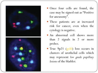  Once four cells are found, the
case may be signed out as “Positive
for aneusomy”.
 These patients are at increased
risk for cancer, even when the
cytology is negative.
 An abnormal cell shows more
than 2 signals in 2 or more
probes.
 True 9p21 (gold) loss occurs in
clusters of urothelial cells which
may represent low grade papillary
lesions of the bladder.
 