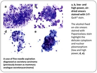 a, b, low- and
high-power, air-
dried smears
stained with Diff-
Quik® stain.
The alcohol-fixed
on-site smears
stained with
Papanicolaou stain
highlight the
delicate cytoplasm
and nuclear
pleomorphism
(low and high
power, d, e).
A case of fine-needle aspiration
diagnosed as secretory carcinoma
(previously known as mammary
analogue secretorycarcinoma)
 