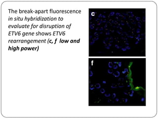The break-apart fluorescence
in situ hybridization to
evaluate for disruption of
ETV6 gene shows ETV6
rearrangement (c, f low and
high power)
 