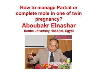 How to manage Partial or
complete mole in one of twin
pregnancy?
Aboubakr Elnashar
Benha university Hospital, Egypt
ABOUBAKR ELNASHAR
 