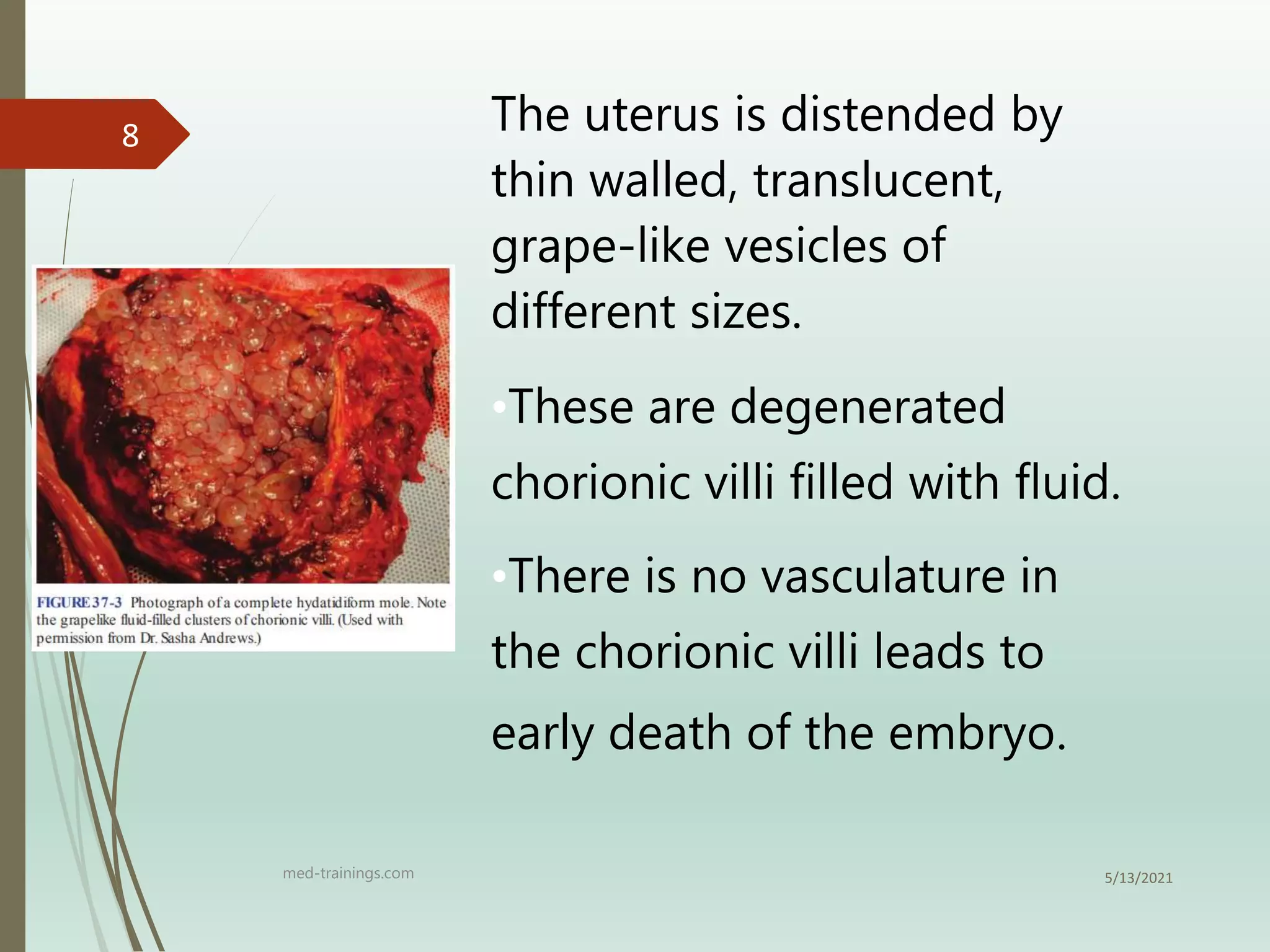 Molar Pregnancy | PPT