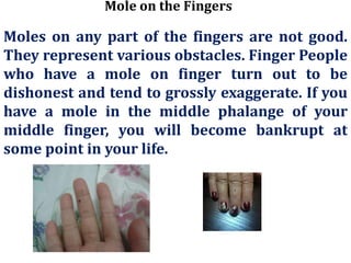 Mole on the Fingers
Moles on any part of the fingers are not good.
They represent various obstacles. Finger People
who have a mole on finger turn out to be
dishonest and tend to grossly exaggerate. If you
have a mole in the middle phalange of your
middle finger, you will become bankrupt at
some point in your life.
 